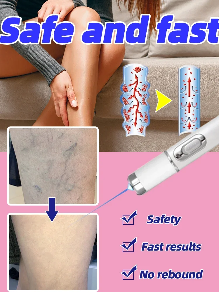 Lampshade Therapy For Varicose Veins Effective Relief Of Dilated Vasculitis In The Legs Phlebitis Improved Blood Circulation