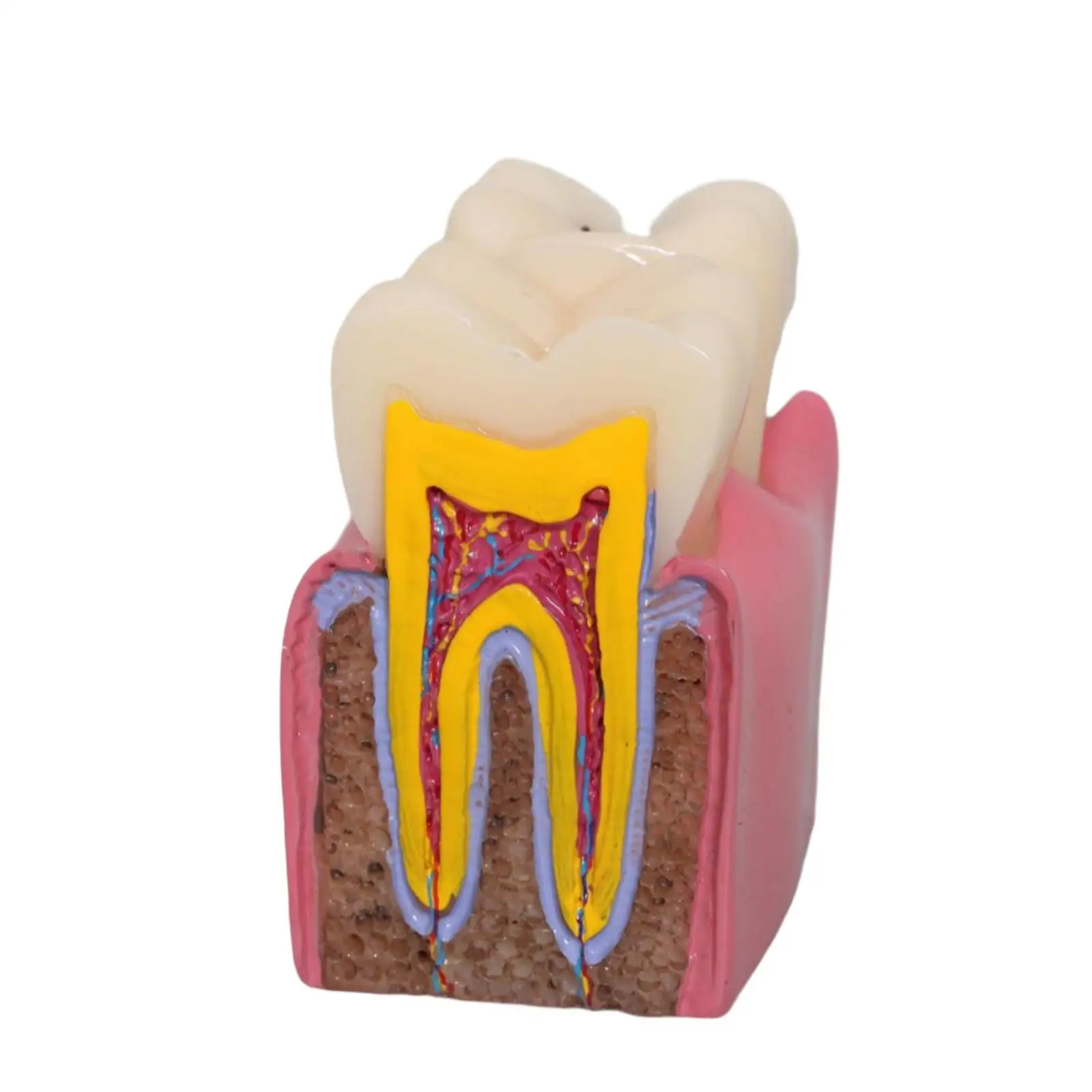 Caries Tooth Model 6 Times Teaching Prop Morphology, Resin ,Tooth Teaching Display for Studying Students Class Education Kids