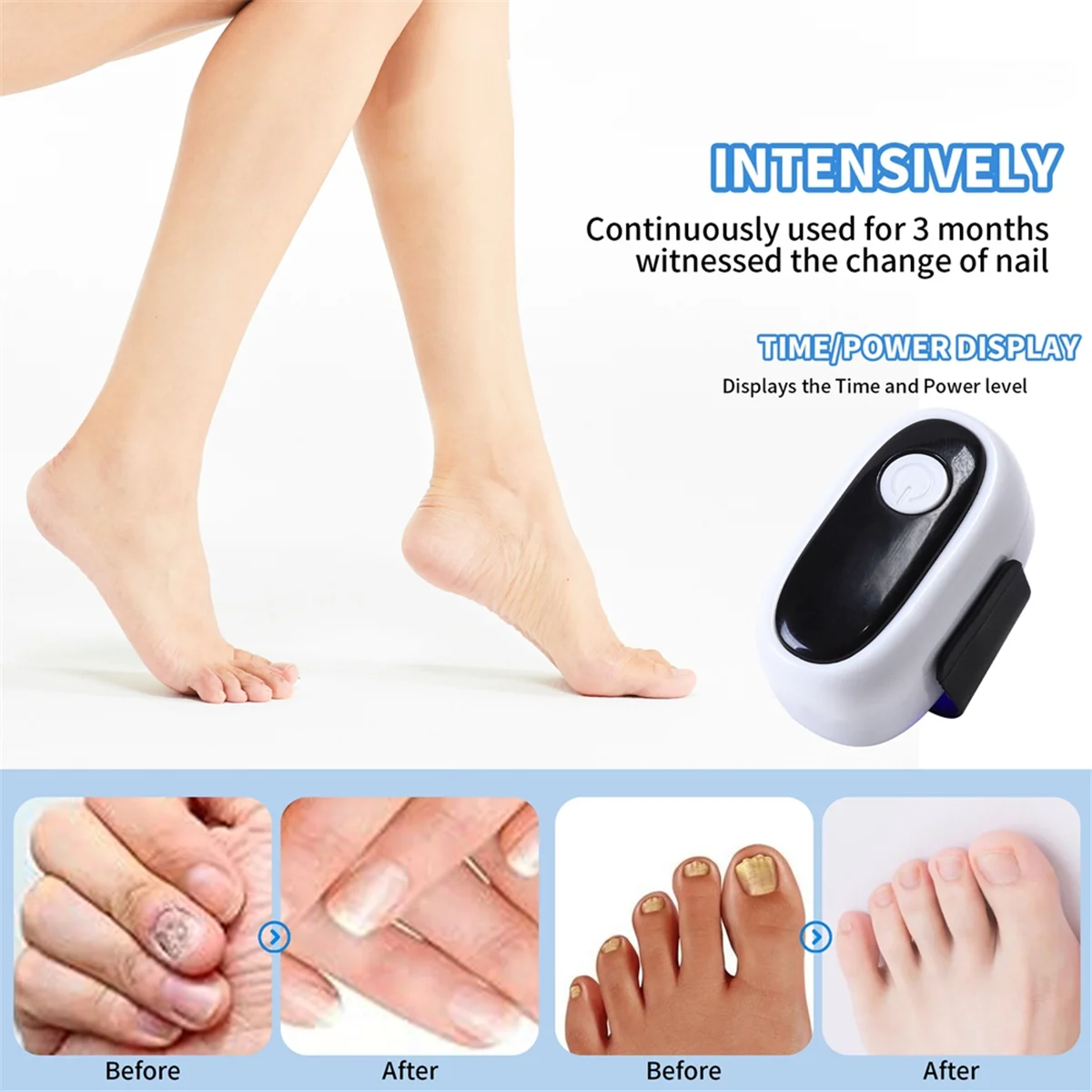 손발톱진균증 치료용 FZFZ 네일 레이저 치료 장치 USB 충전 910nm 적외선 470nm 청색광 네일 살롱 A