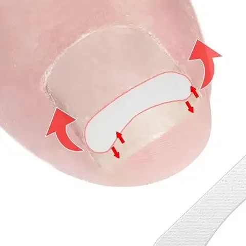 10 個陥入爪矯正ツール矯正クリップブレース陥入爪治療弾性パッチステッカーペディキュアツール