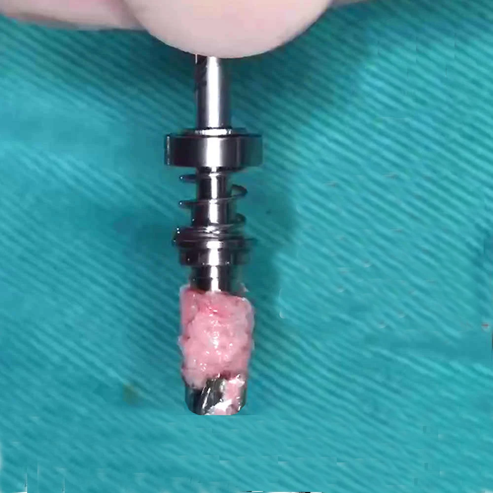 Dental Trephine Burs Implant Bone Spring Bone Harvesting Drill Self-grinding Bone Powder Collection Drill - Image 3