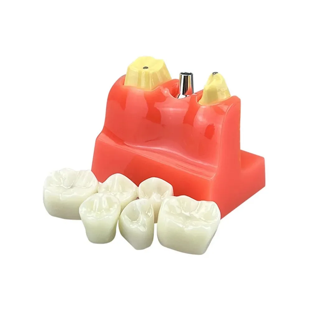 4 Times Dental Implant Teeth Model Teach Implant Analysis Crown Bridge Removable Model Dentist Teaching Demonstration Model