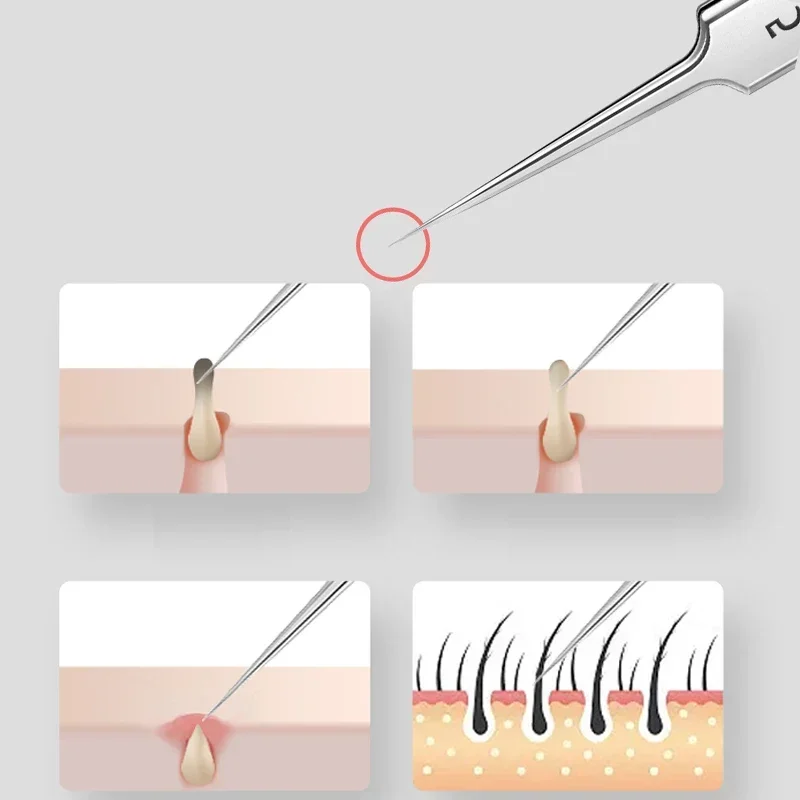 Higt Quality Acne Blackhead Removal Kit Nose Face Pore Cleansing Acne Needle for Ingrown Hair Comedones Extractor Skin Care Tool