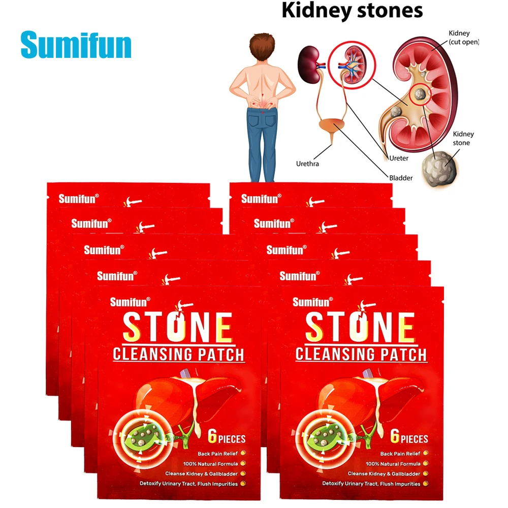 

60Pcs Renal Calculus Removal Plaster Treat Kidney Stones Gallstones Chinesse Medicinal Patch Urolithiasis Pain Relief Sticker