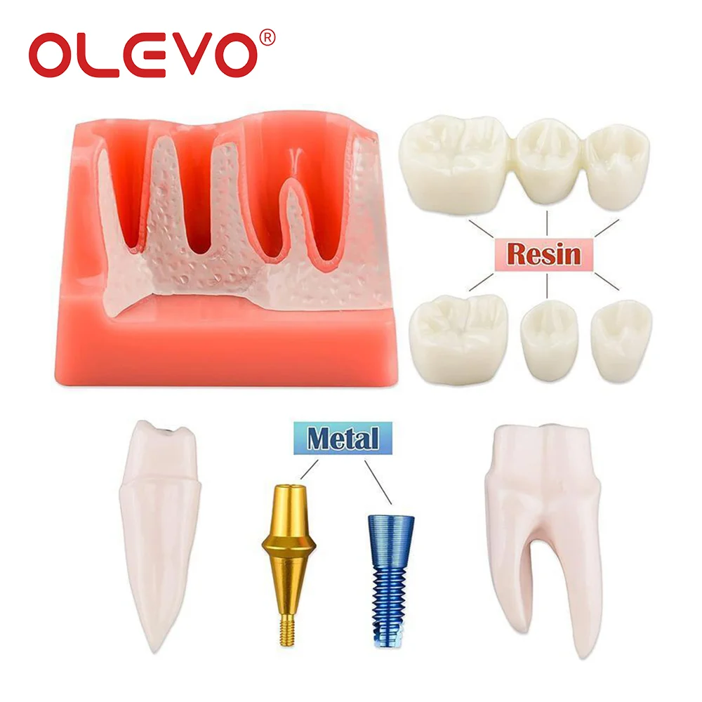 OLEVO 4 Times Dental Implant Teeth Model Analysis Crown Bridge Demonstration Removable Dentist Teaching Training Student Study