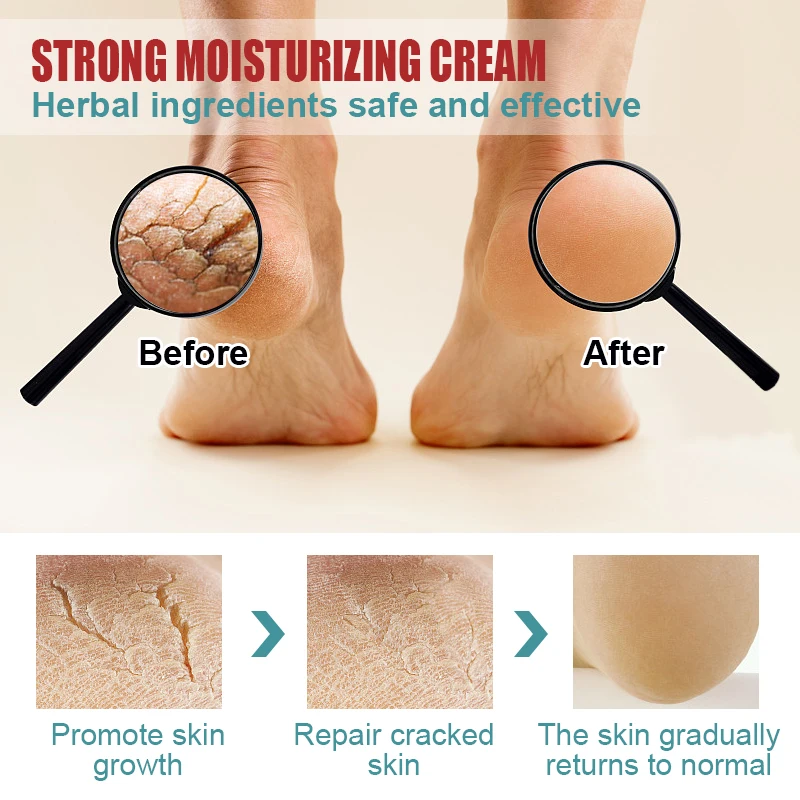 1pcs Foot Chap Treatment Cream Repair Hand Heel Chap Moisturizing Cream Frostbite Reduce Wrinkle Skin Dry Itch Skin Care S012