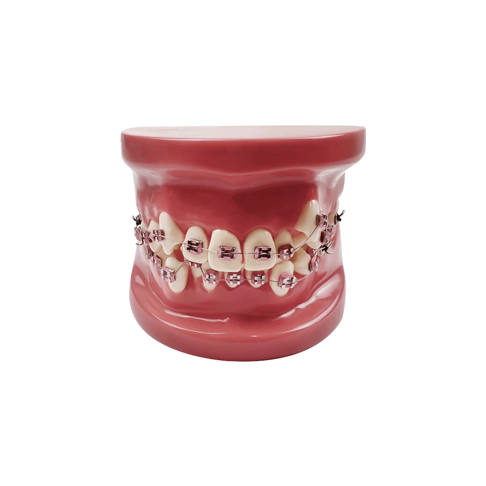 Dental Orthodontic Treatment Tooth Teaching Model With Metal Bracket Tooth Malocclusion Practice Model For Dentist Demonstration