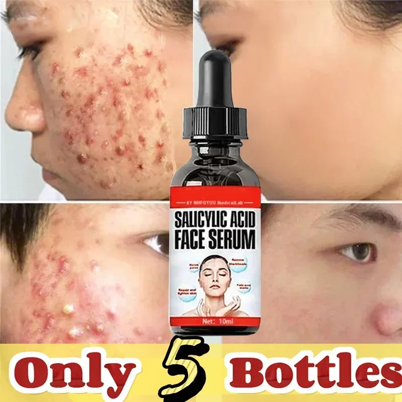 

Acne removing essence, moisturizing, repairing and oil controlling