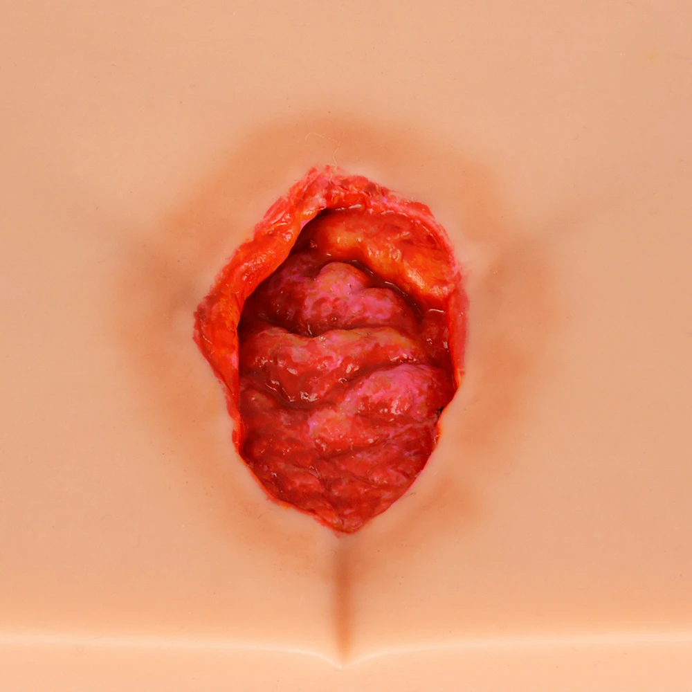 زخم ضغط السيليكون (المرحلة 1-4) نموذج تمريض مظاهرة، محاكي السيليكون، نموذج للتدريس