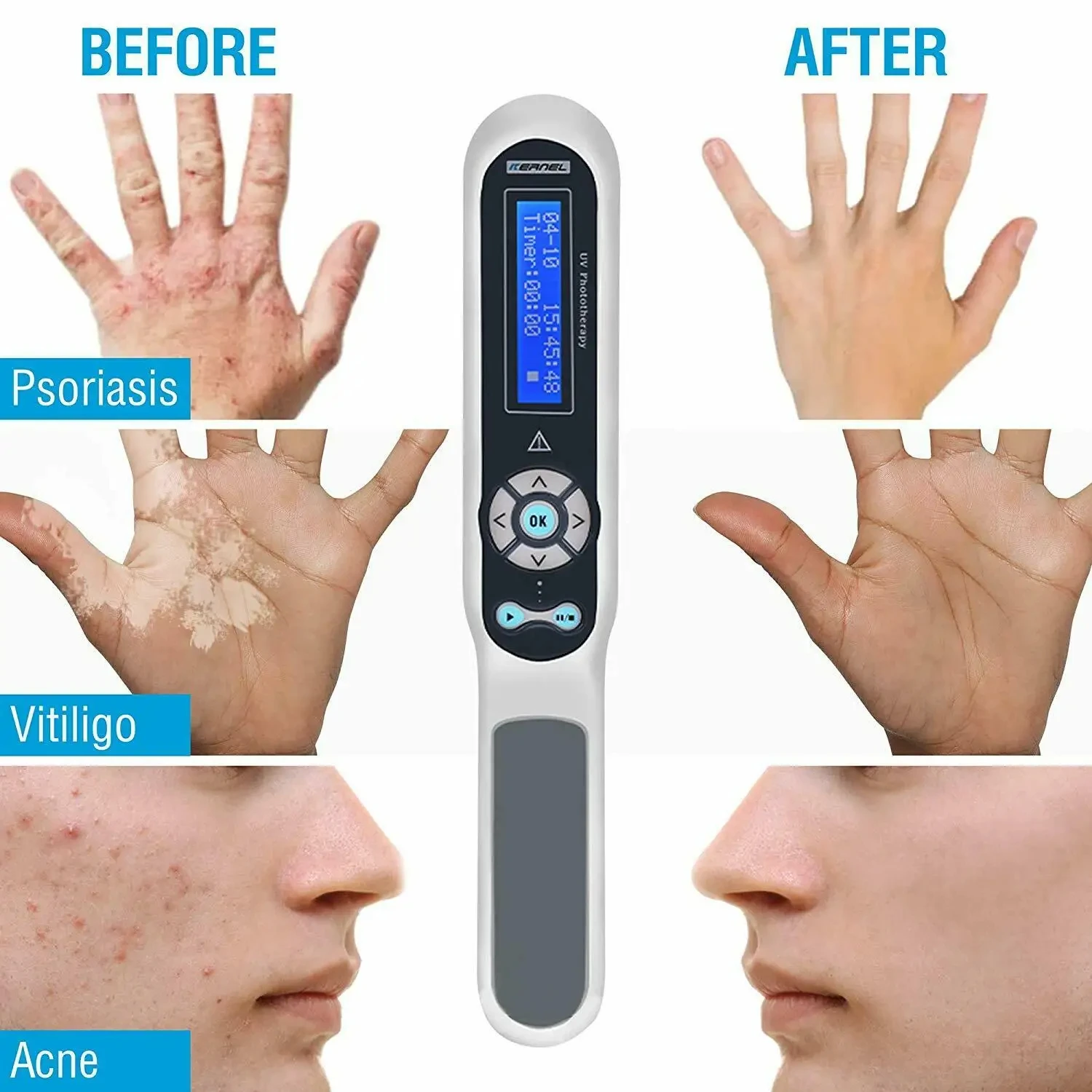 FODRK Home Use Psoriasis Equipment 311nm UV Lamps Phototherapy Medical Device UvbTreatment Light For Vitiligo