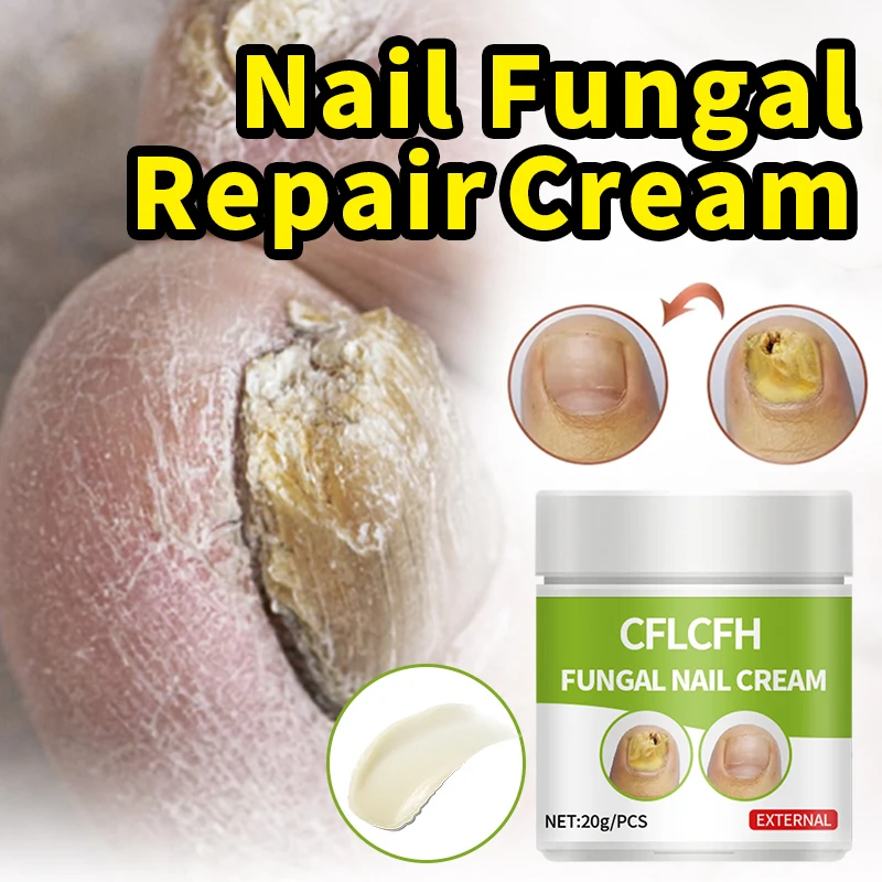 Nail Fungal Treatment Cream Onychomycosis Repair Nail Ointment Correction Paronychia Anti Infection Toe Fungus Removal Foot Care