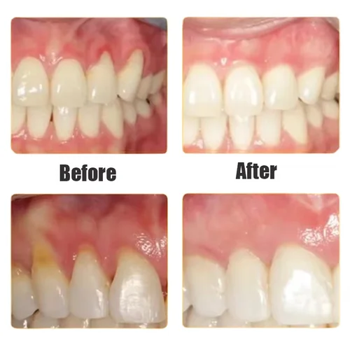 Imagen 2 del producto Suero de Gel para el cuidado de la reparación de las encías dañadas, alivia las encías dolorosas, alergias, limpieza profunda, manchas de dientes, sarro, pasta de dientes para caries dentales