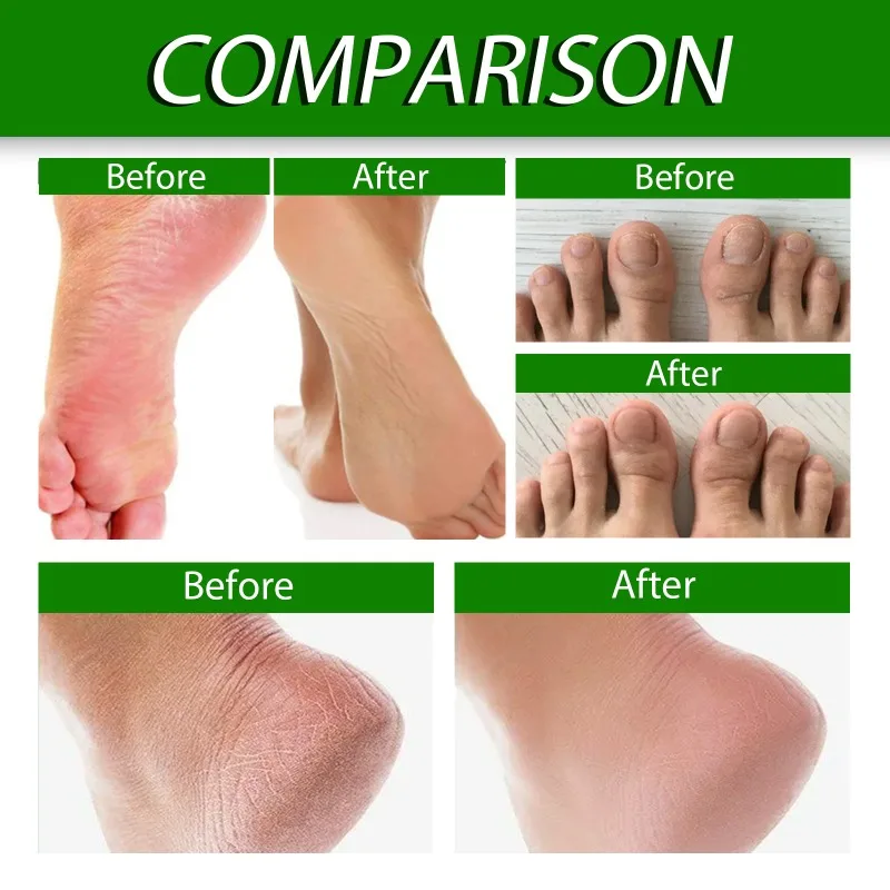 Foot care cream heel Dead skin removal Callus anti dry Cracked peeling hydrating moisturize exfoliation chapped repair feet mask