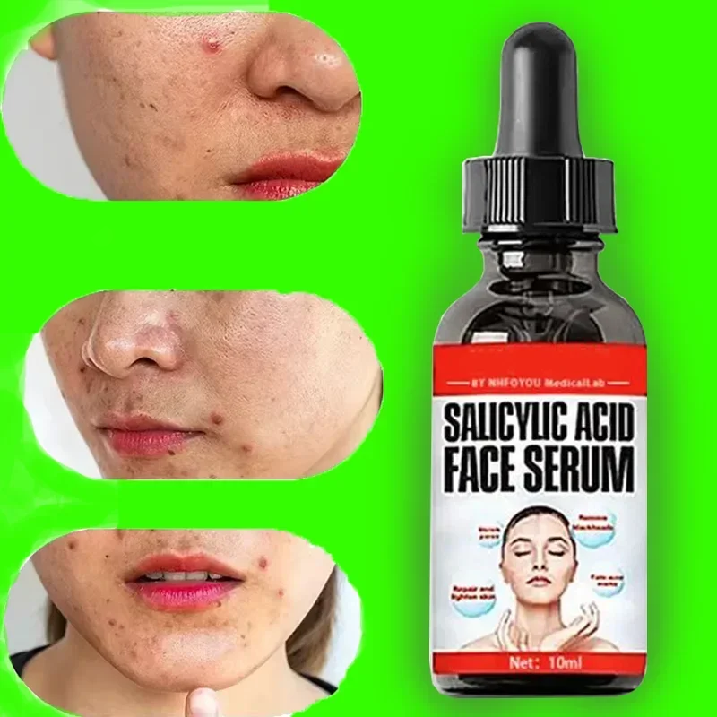 Líquido Eficaz para Remoção de Acne, Solução Conveniente para Reparação Facial, Produtos Suaves para Cuidados com a Pele, Confortável