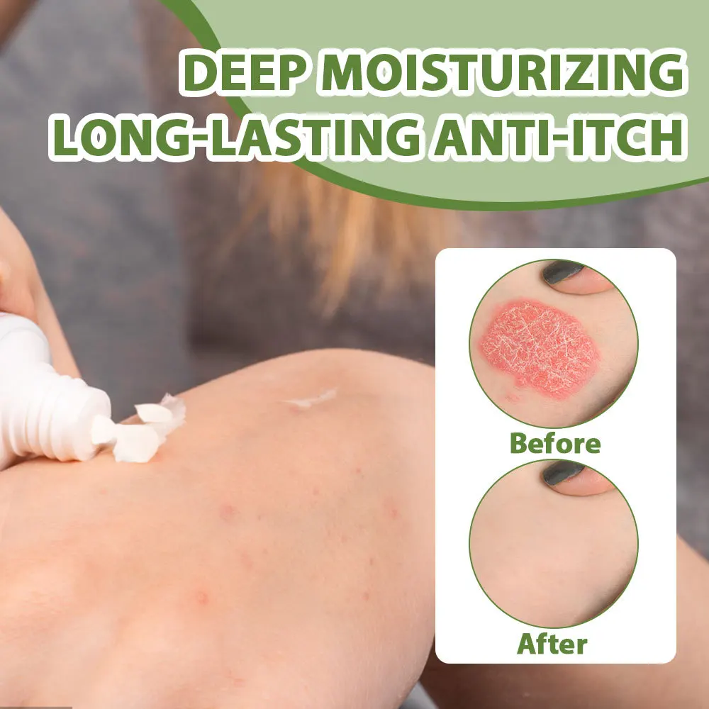 كريم إزالة حب الشباب للجسم علاج الوجه بعقب الظهر علامات حب الشباب إصلاح سلس كريم جلد الدجاج ترطيب تبييض العناية بالبشرة