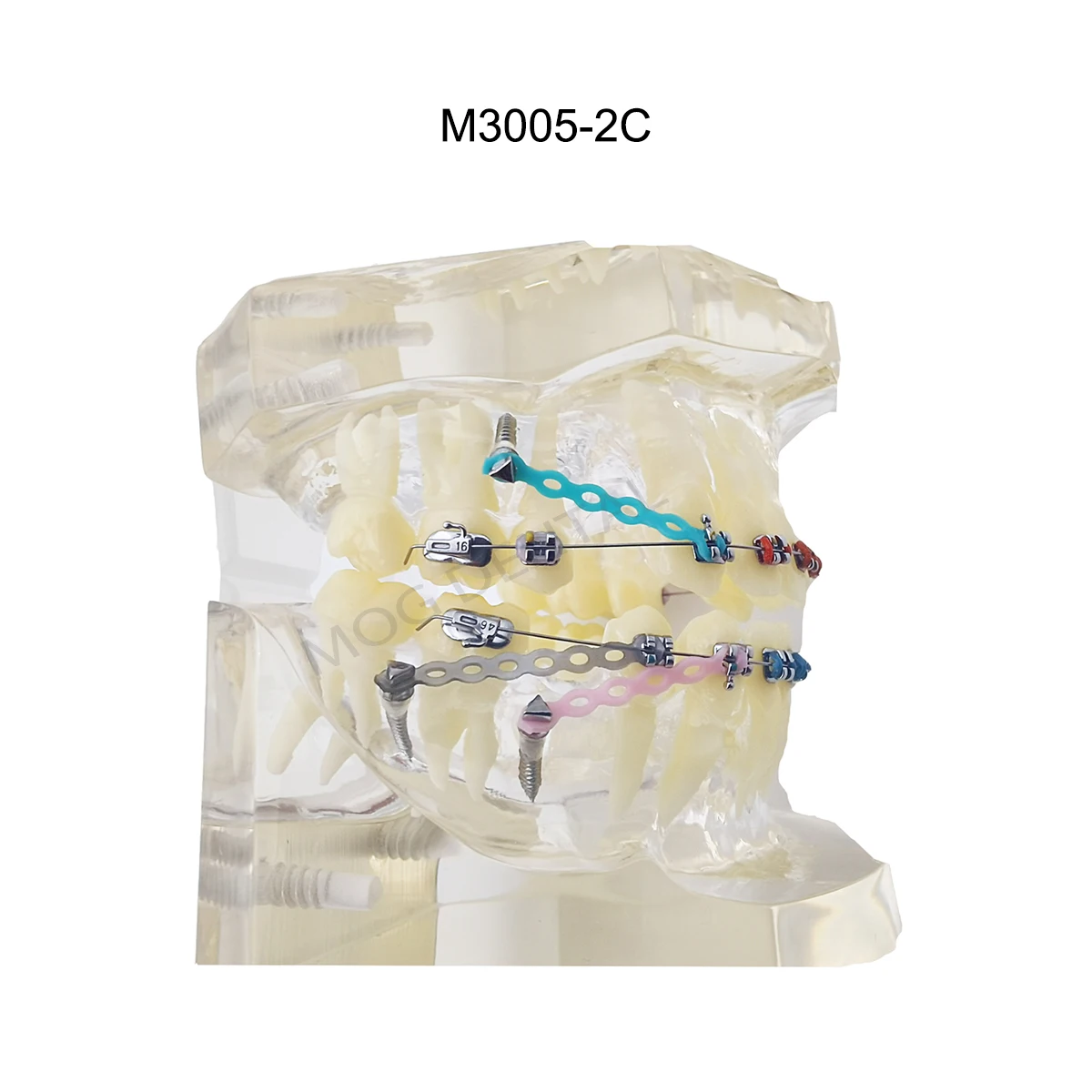 Dental Model with Orthodontic Bracket Dental Teaching Model For Dentist Treatment Demo Training Studying