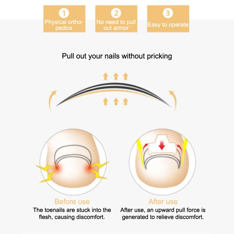 1 set di strumenti per la correzione dell'unghia del piede pedicure recuperare incorporare il trattamento delle unghie dei piedi strumento professionale per la correzione della cura del piede
