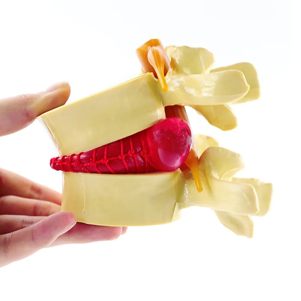 

Модель поясничного отдела позвоночника с грыжей межпозвоночного диска, из прочного ПВХ, анатомический дизайн, для медицинского обучения, обучения пациентов и демонстрации.