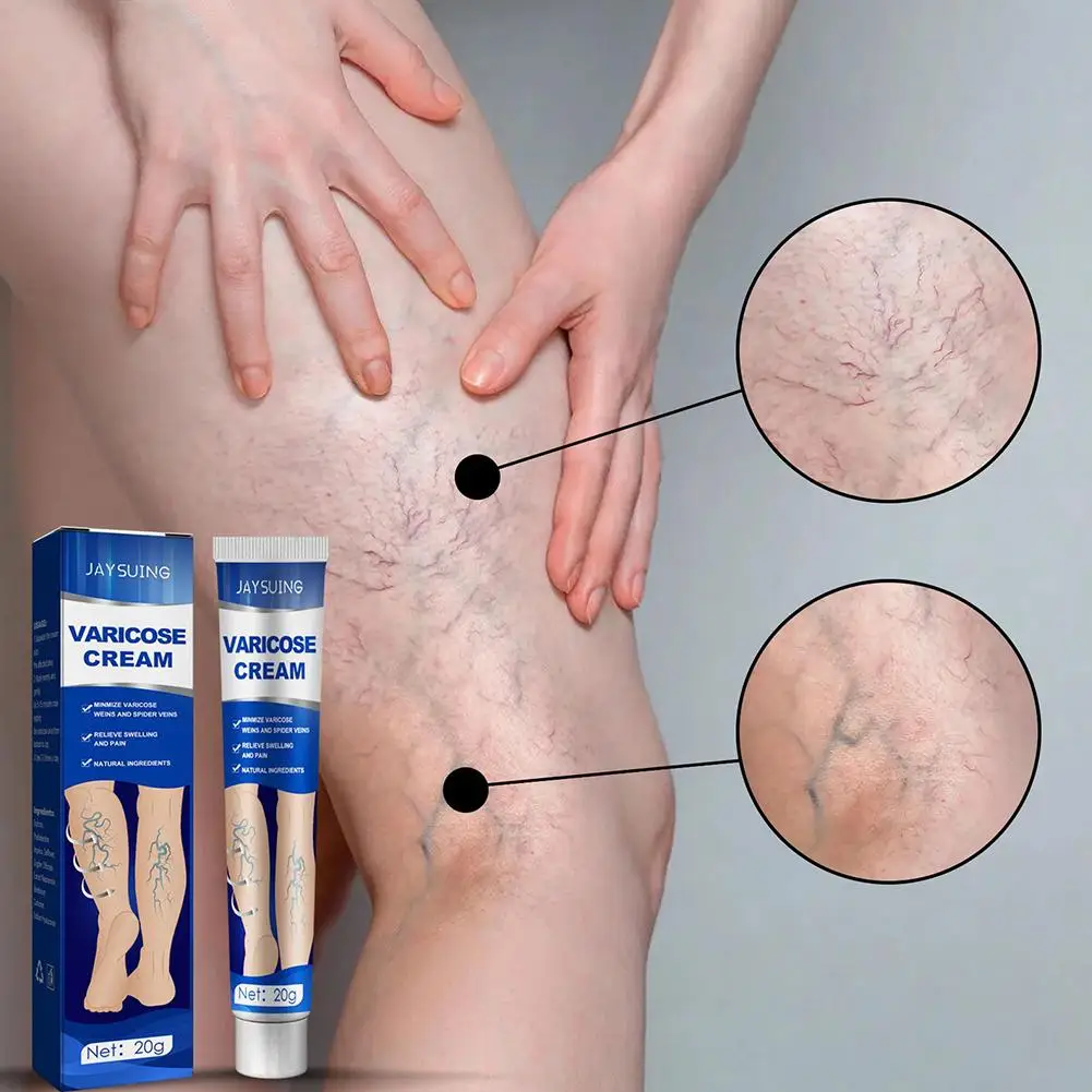 Salbe gegen Krampfadern. Effektive Creme zur Linderung von Krampfadern zur Linderung von Bein-Vaskulitis, Venenentzündung, Spinnenschmerzen, Pflege