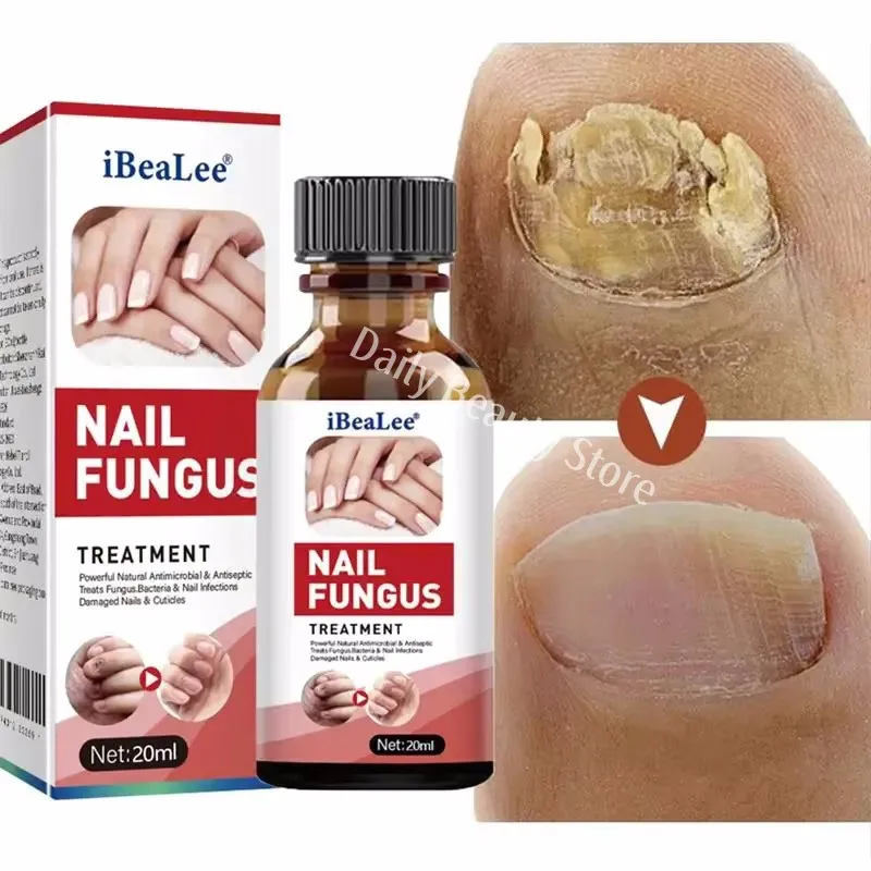 Fungal Nail Treatment Serum Nails Fungus Removal Treating Paronychia Liquid Anti Gray Nails Toe Infection Foot Repair Care Tools