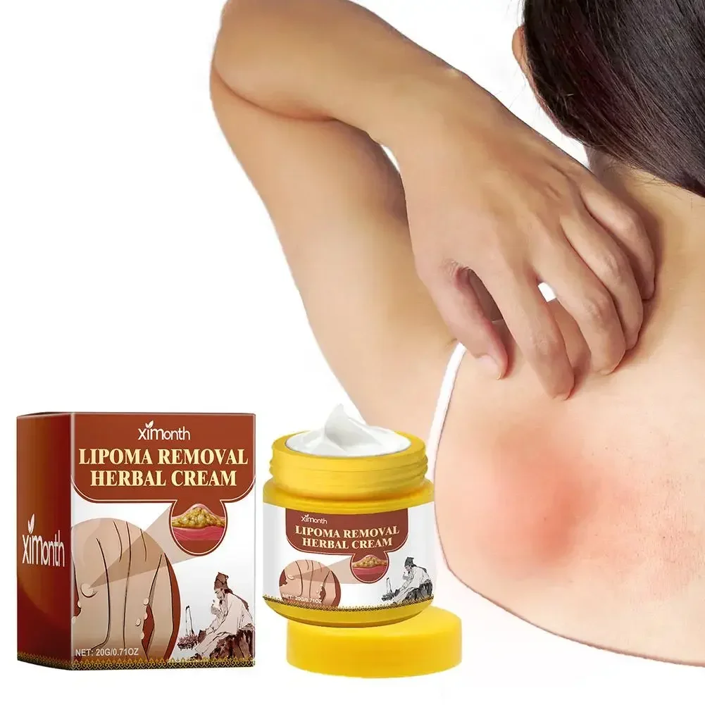 20g Lipoma Cream Subcutaneous Lumps Remover Treatments Skin Swelling Cellulite Fibroma Fat Mass Plaster