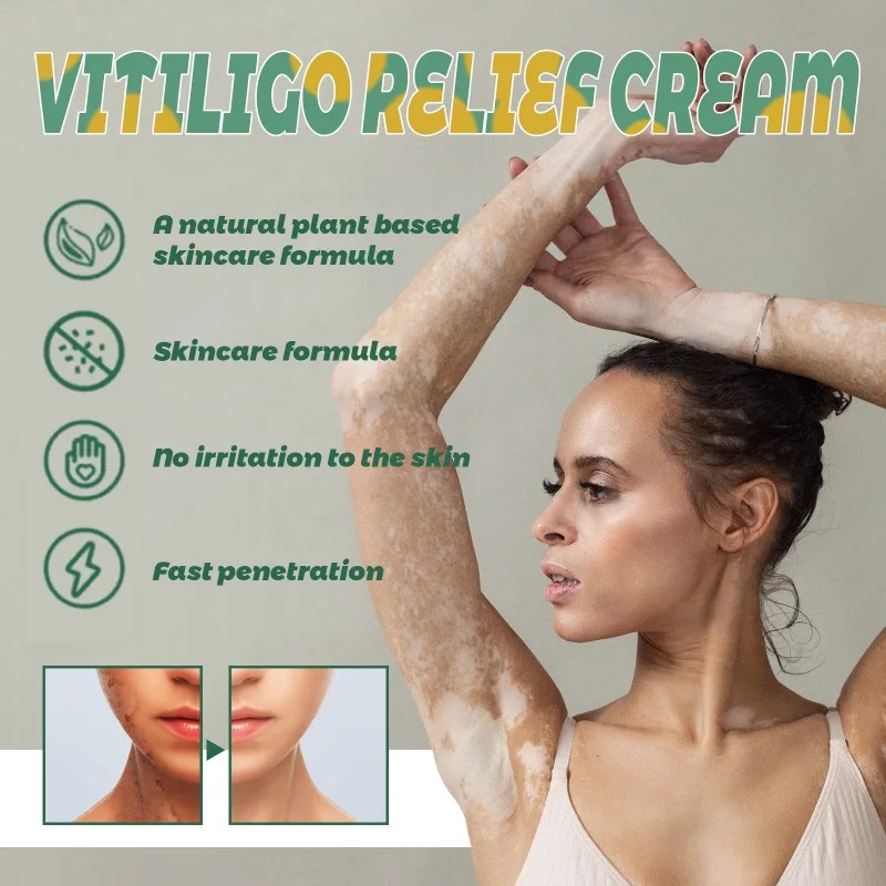 Ungüento de Vitiligo para eliminar eficazmente el Vitiligo, pomada de reparación Natural, elimina la tirita, manchas blancas, elimina el Vitiligo de la piel, cuidado de la piel, 20g