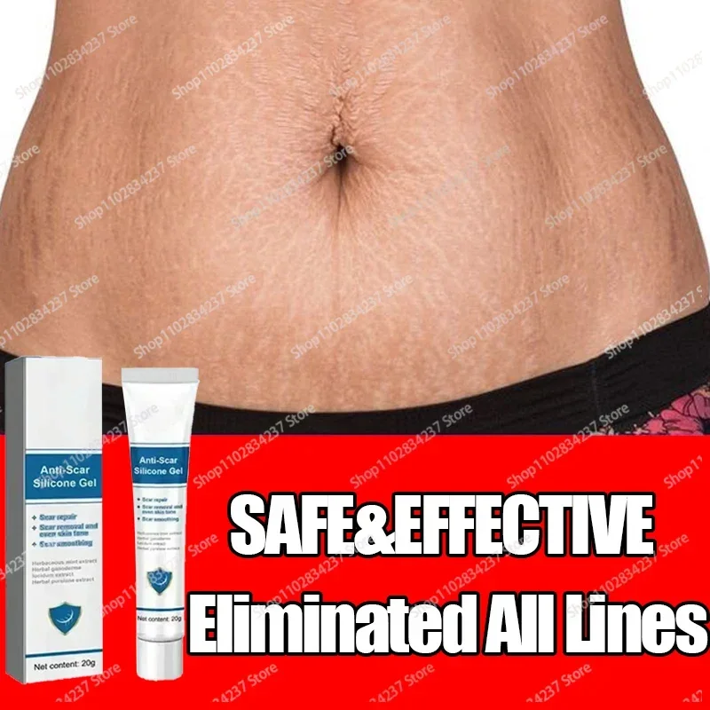 Eliminate Red White Old Stretch Marks Cream For Pregnant Women