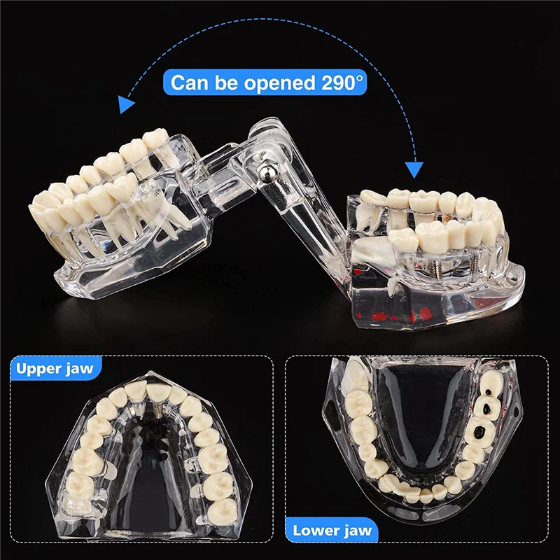 Modello di denti per malattie trasparenti con ponte per impianto dentale, modello dentale per l'educazione del paziente e degli studenti odontotecnici