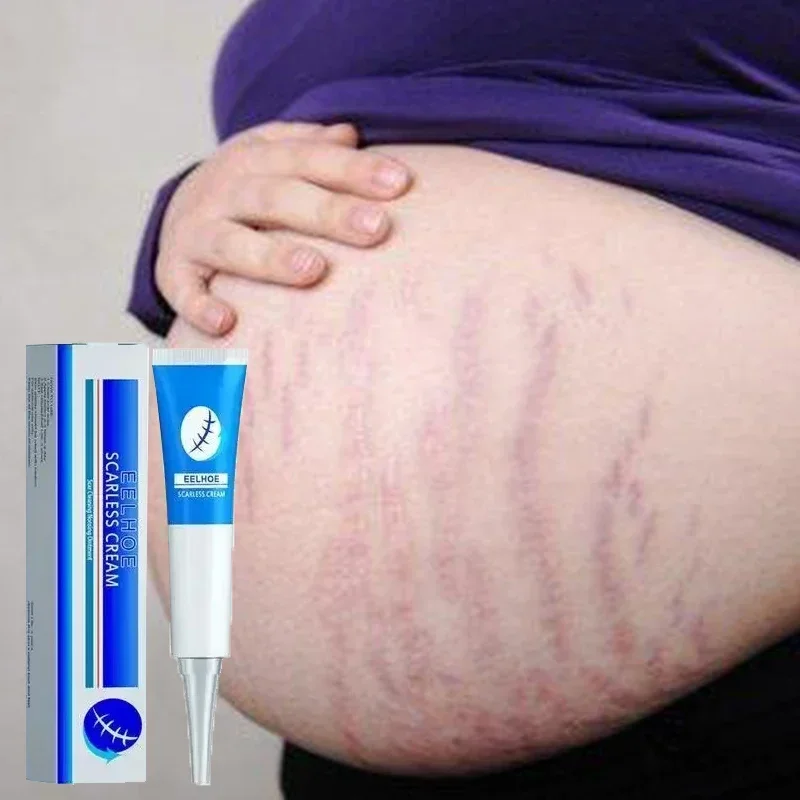 

Pregnancy Stretch Mark Repair Cream Maternity Obesity Skin Postpartum Stretch Scar Body Mark Remover Smooth Ointment