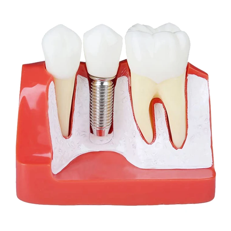 GTBL Teeth Demonstration Model Implant Removable Analysis Crown Bridge For -Patient Communication