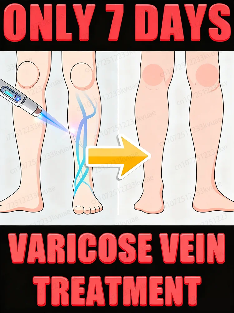 Pluma de tratamiento venoso láser de segunda generación, utilizada para tratar venas varicosas