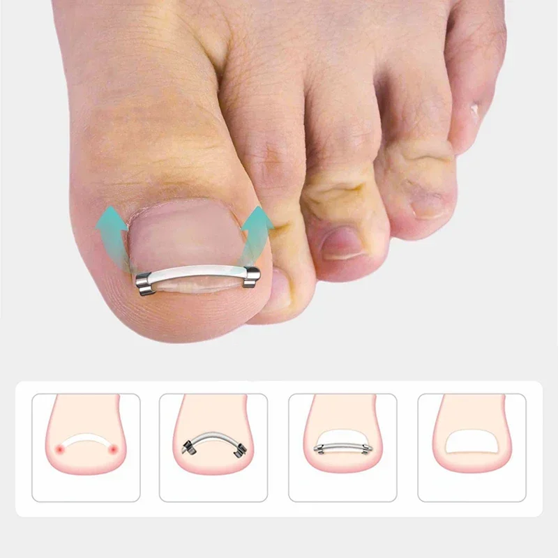 Strumento per pedicure dell'unghia del piede incarnita incorporato Cura delle unghie dei piedi Raddrizzamento Clip di correzione Morsetto curvo Strumento di correzione delle unghie dei piedi per le dita dei piedi