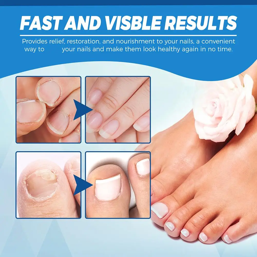 1Pcs Nail Fungus Treatment Pen Anti-fungal Repair Pen Blue Light Laser Pen Paronychia Onychomycosis Painless Nail Repair Kit