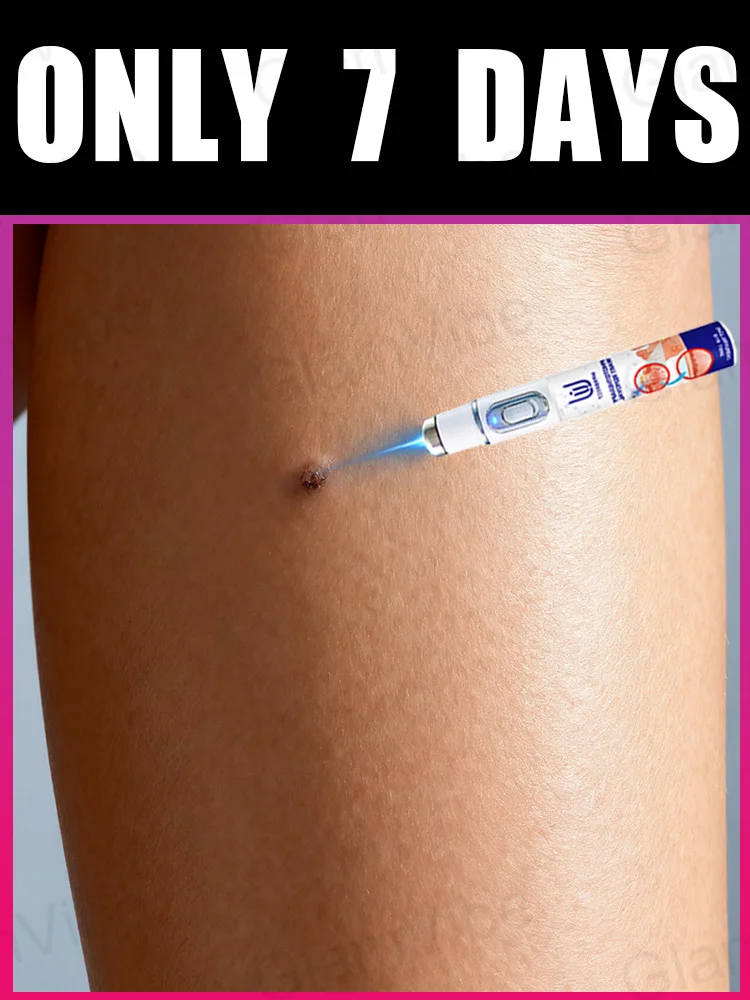 

2025 New Upgrade Blue Laser Solve Wart Tool