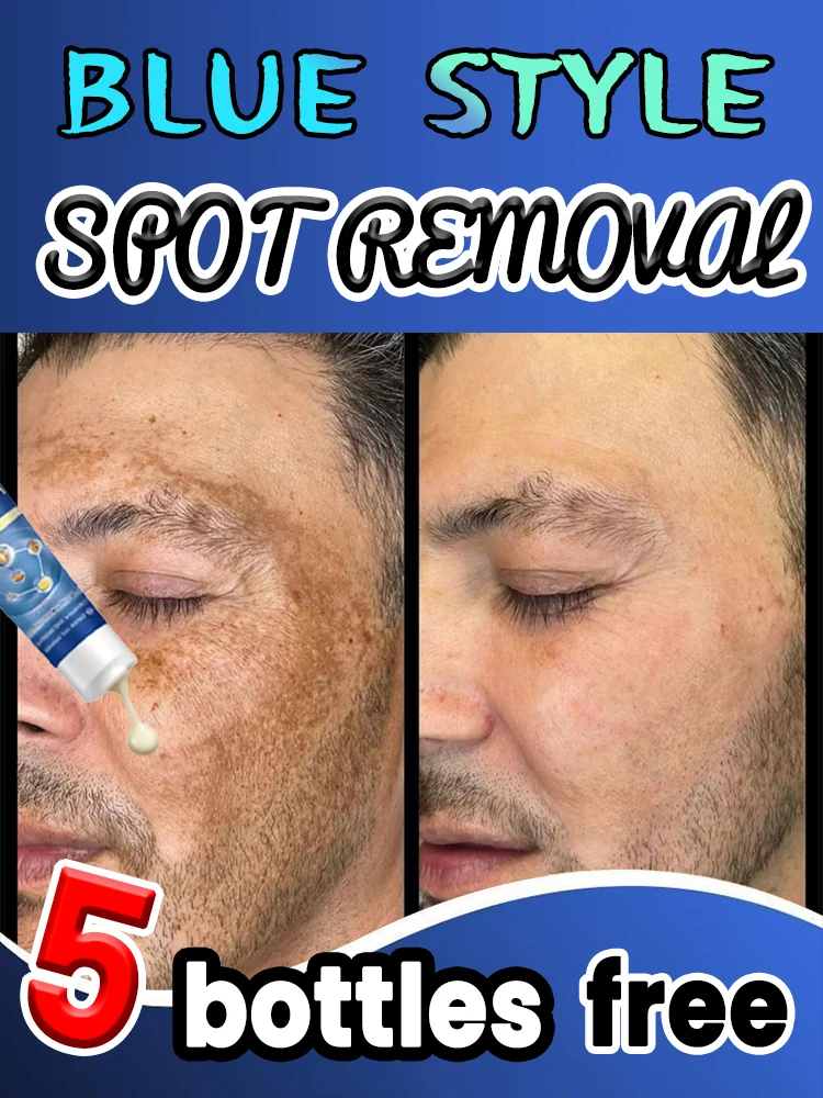 أفضل منتجات إزالة البقع والالبقع الداكنة من AliExpress