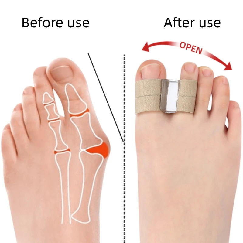 Separador de dedos de los pies, herramienta para el cuidado de los pies, Corrector de juanete, ortopédico, ajustador de pulgar, alisador de pedicura, Hallux Valgus, 1 piezas