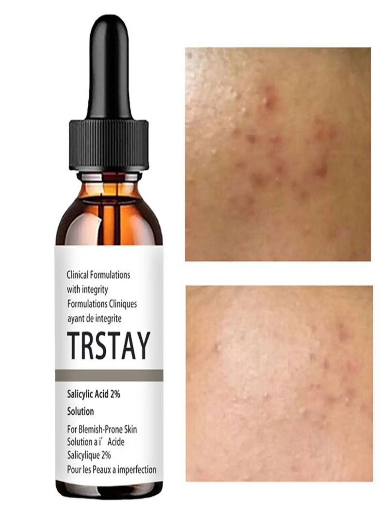 Salicylic Acid 2% Solution Essence Acne Spot Removing Shrink Pores Oil-Control Brighten Face Skin vitamin c serum for face