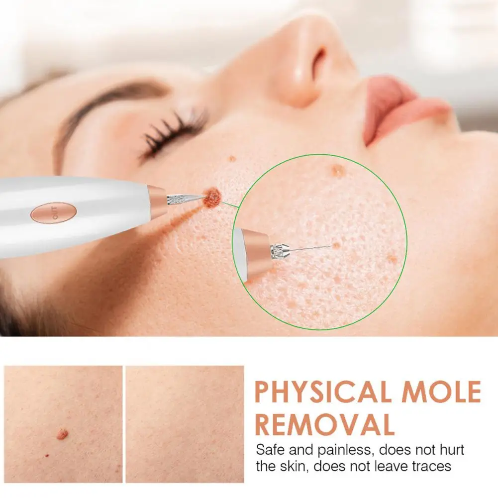 Mole Remover Pen Plasma Technology Skin Tag Remover Portable Skin Tag Removal Kit Painless Mole Wart Skin Tag Remover for Girls