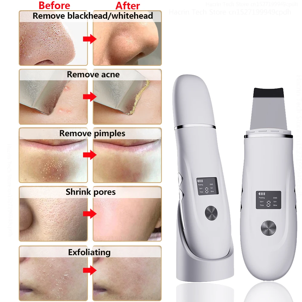 Ultrasonic Peeling Remover Blackhead Facial Skin Scrubber Deep Cleaning Face Lifting Removal Pore Acne Facial Shovel Cleanser