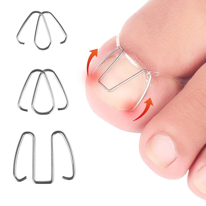 Nail Art Ingrown Toe Nail Correction Tool Toenail Nail Orthosis Paronychia Clip