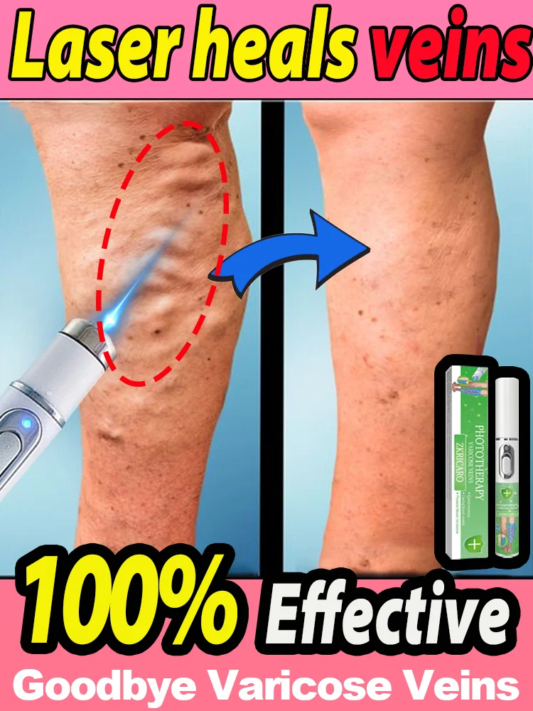 

Laser Therapy Heals Leg Veins