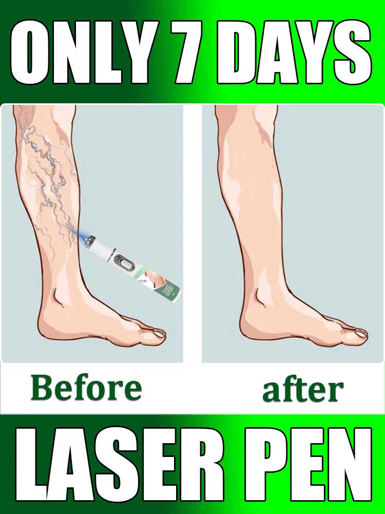 

Hot-selling leg care tool, blue light pen to solve varicose veins