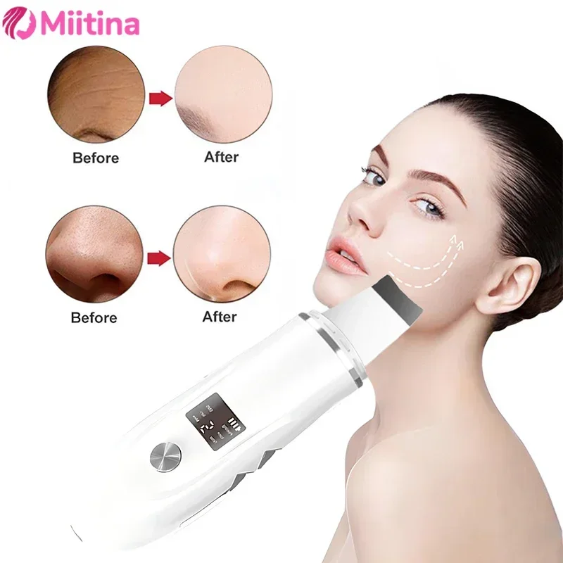 Ultrasonic Vibration Skin Scrubber, Espátula Facial, Removedor de cravos, Limpeza de pá, Removedor de poros iônicos, Peeling Lifting Skin Care