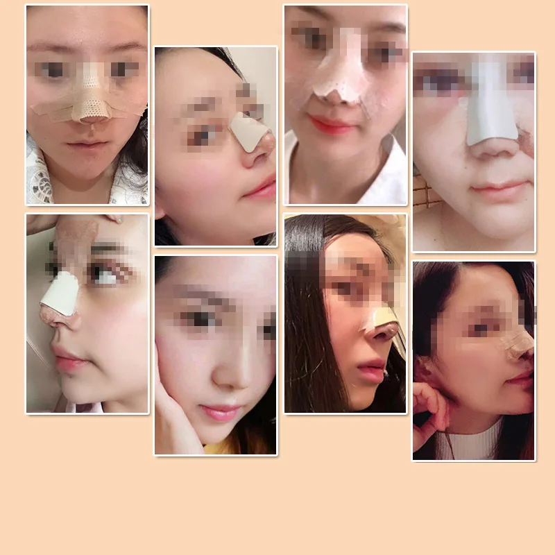 

Medical low temperature thermoplastic nasal splint cosmetic plastic augmentation rhinoplasty fracture fixation nasal splint