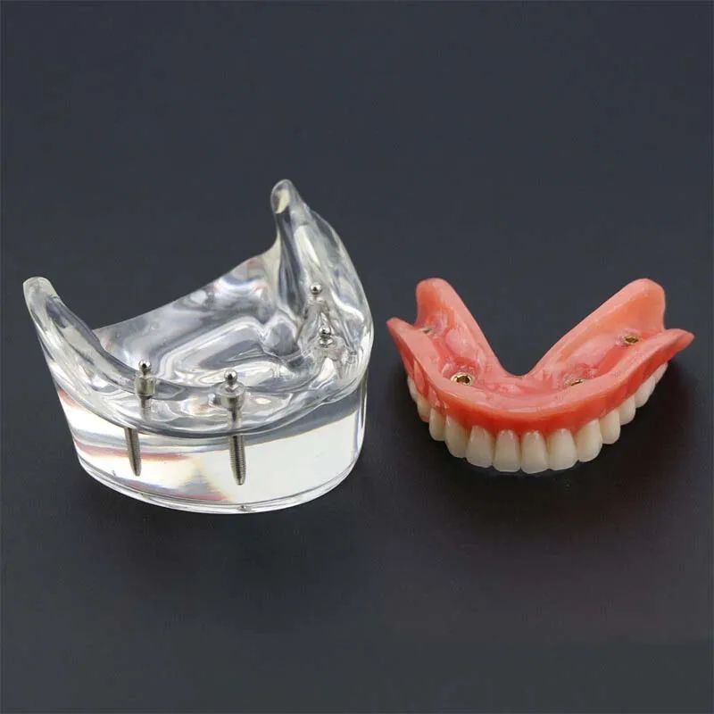 Dental Teeth Model with Implant Overdenture Model Inferior Demo Teeth Model for Dentist Study Dental Teaching Model 2/4 Implants