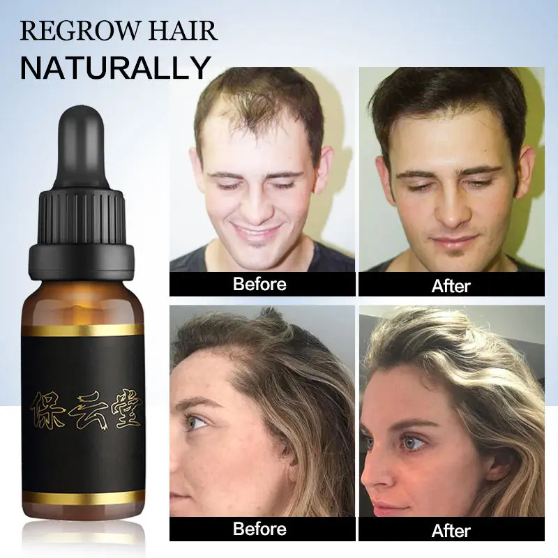 Fast Hair Growth Essence Anti Hair Loss Controls Hairfall Penetrates Deep Into Hair Root To Promote Hair Regeneration 30ML