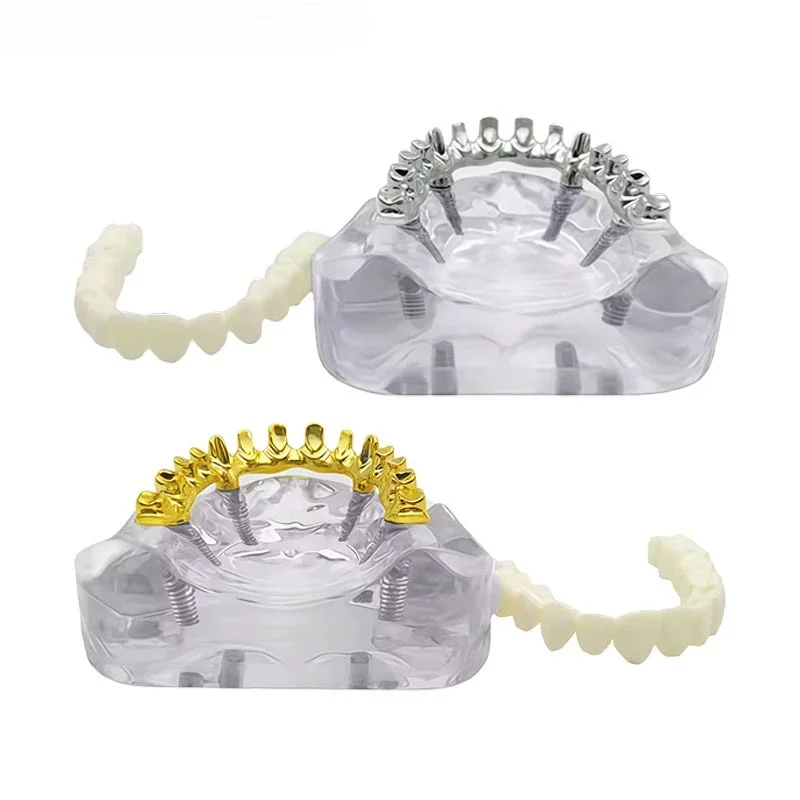 Dental Implant Teeth Model Transparent Lower Jaw Type Overdenture Modle With 4/6 Removable Screws for Researching Medical