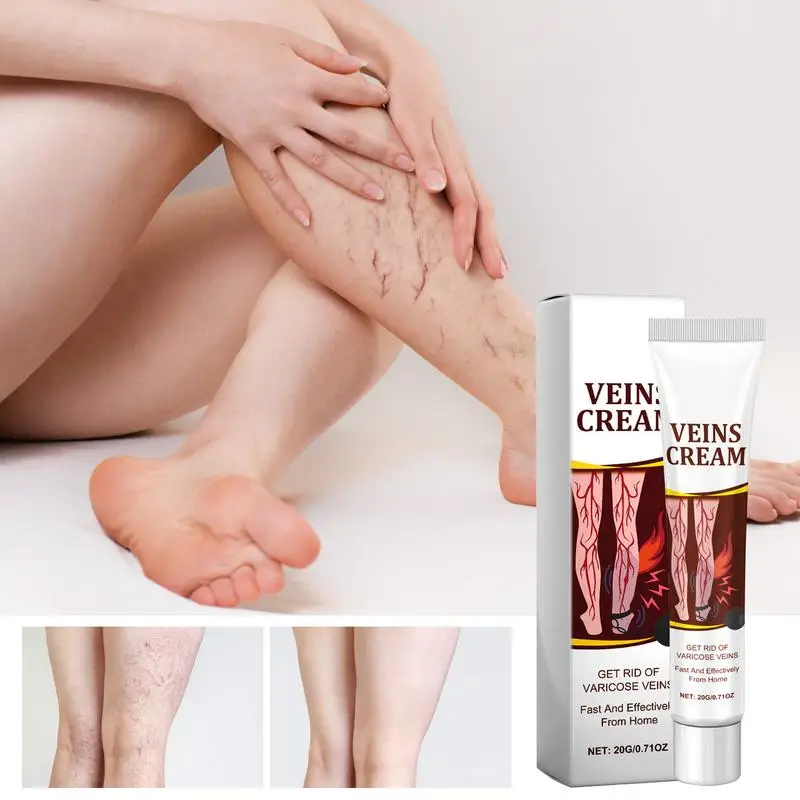 Varicose Cream Veins care cream Relieve Swelling caused by bulging veins in the legs Veins massage care cream