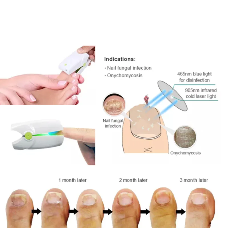 905NM painless nail fungus treatment device, laser hand and foot care whitening and fungal infection removal for onychomycosis