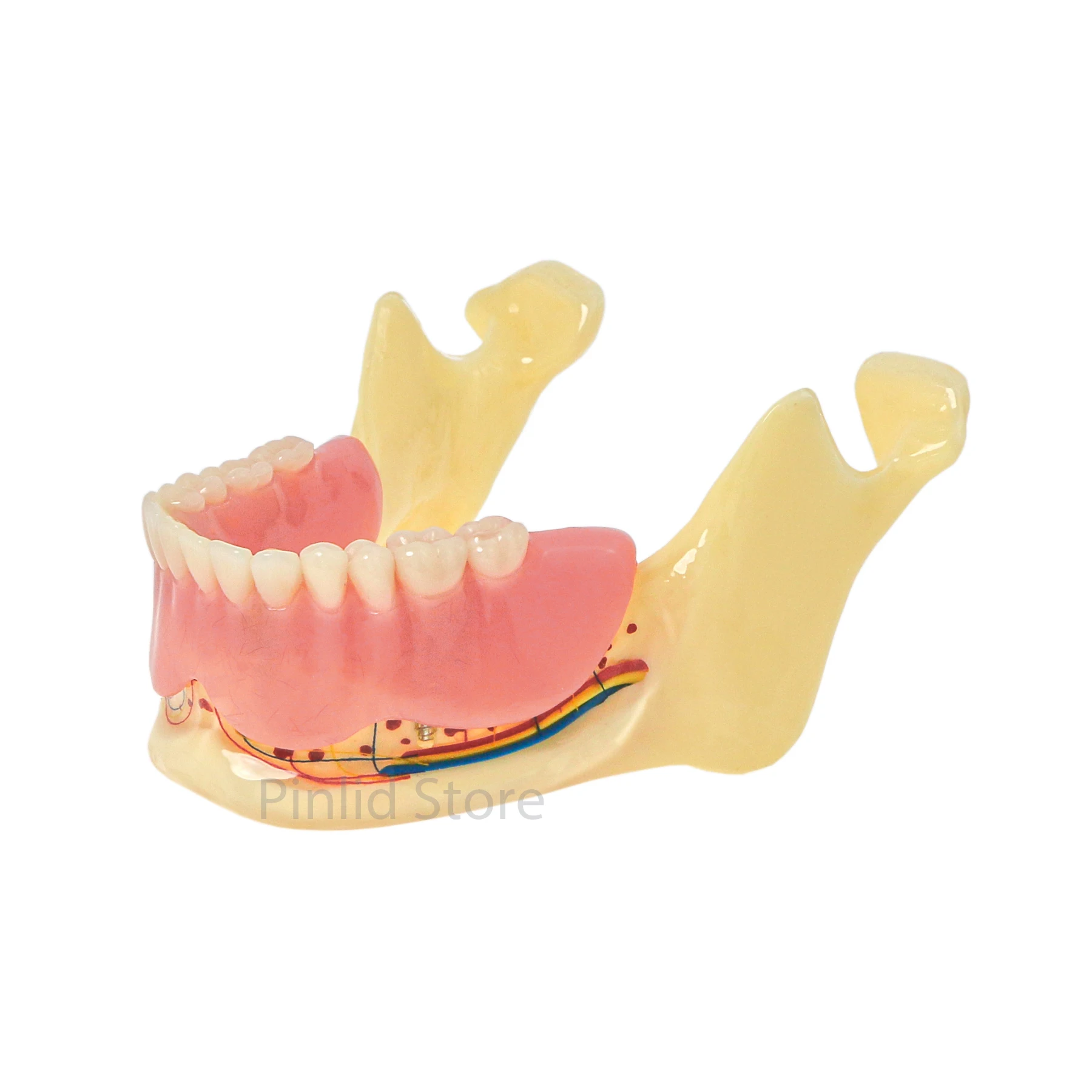 

Dental model mandibular implant Overdenture magnetic attachment mandibular M6005